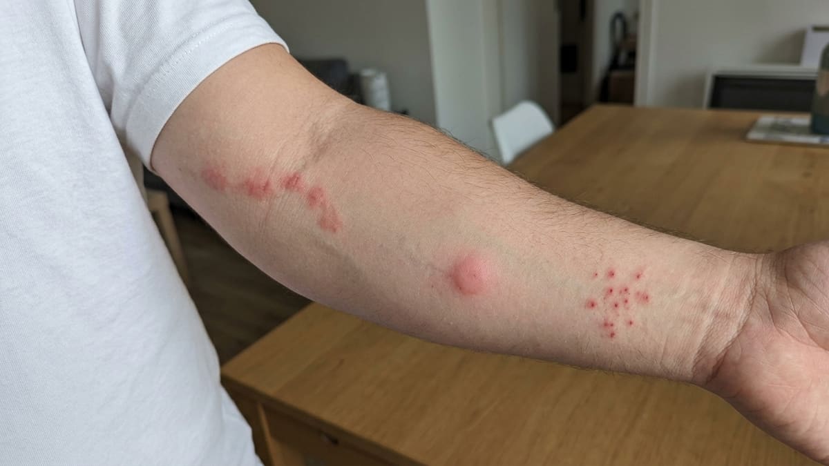 Différencier piqûre de punaise de lit, moustique et puce